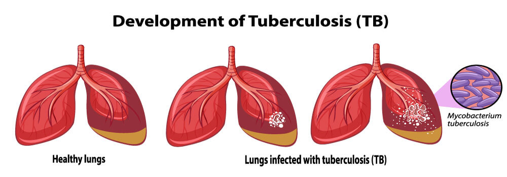 Healthy lungs and lungs infected with Tuberculosis - side effect of Humira